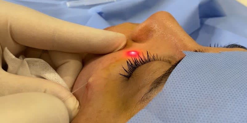 Endolift: Minimal İnvaziv Estetikte Yeni Nesil Çözüm